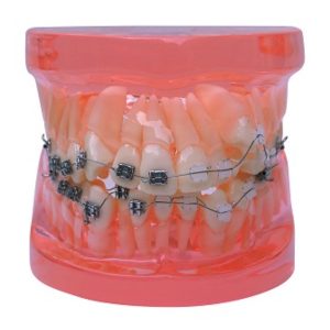 Product List Semi metal and semi ceramic orthodontic model A7006 front