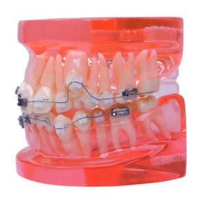 Product List Semi metal and semi ceramic orthodontic model A7006 left