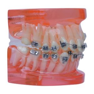 Product List Semi metal and semi ceramic orthodontic model A7006 right