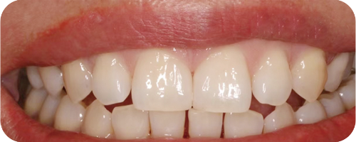 Application cases of anterior glass ceramic crowns